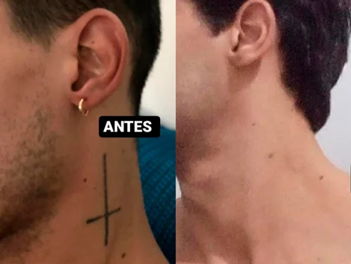 Resultado remoção 6